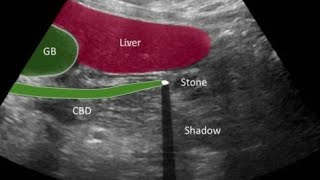 Gallbladder Stone Ultrasound [upl. by Dorran318]