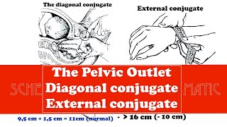 The Pelvic Outlet Diagonal conjugate and External conjugate [upl. by Othe134]