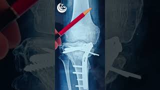 Intraarticular osteotomy [upl. by Aliahkim]