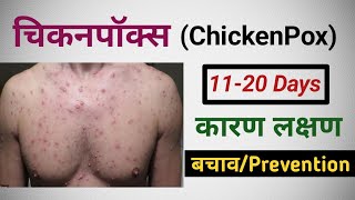 Chickenpox  Symptoms  Causes In Hindi  चिकनपाॅक्स छोटी माताchicken pox [upl. by Atnicaj770]