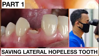 Step by Step Saving Lateral Hopeless Tooth Part 1  General Dentist Griya RR [upl. by Sineray]