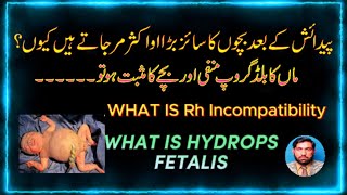 What is Hydrops Fetalis ماں کا بلڈ گروپ منفی ہو اور بچے کا مثبت ہو تو بچے پر کیا اثرات ہوتے ہیں۔ [upl. by Alrahs508]