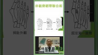 韌帶聯合術有什麼程序What is the syndesmosis procedure [upl. by Tapes]