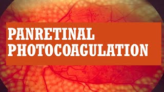 LASER TREATMENT FOR DIABETIC RETINOPATHY  PAN RETINAL PHOTOCOAGULATION  PRP [upl. by Jill]