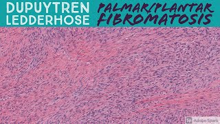 Palmar Fibromatosis Dupuytren Contracture amp Plantar Fibromatosis 5Minute Pathology Pearls [upl. by Prosser]