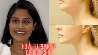 Double chin treatment in Hyderabad Telugu [upl. by Yatnahc]