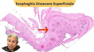 Theres nothing more satisfying in the esophagus than this diagnosis 🥳📚🔬 [upl. by Eelirrem]