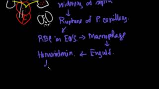 Brown induration of lung BN  Pathology  Pathology Short Video [upl. by Holbrooke]