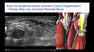 Ultrasoundguided nerve hydrodissection for pain management – Supplementary video 1 ID 247208 [upl. by Elleimac]