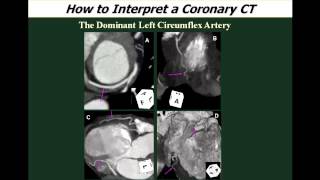 CCTA Lecture XI Practical and Efficient CCTA Analysis and Clinical Interpretation [upl. by Ellenwahs549]