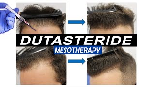 Mesotherapy with Dutasteride Injections Pros and Cons and what Results to expect [upl. by Kra]