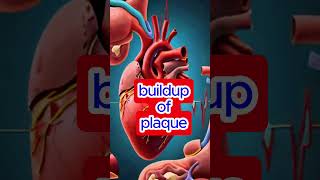 Causes of a heart attack health HeartHealthHeartAttack bloodpressure healthyliving cardiology [upl. by Grof]