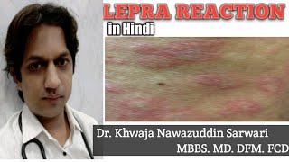 Lepra Reaction  In Hindi  Medicine  Microbiology  Skin  MBBS  ENL Leprosy Doctors Corner [upl. by Hnahc]