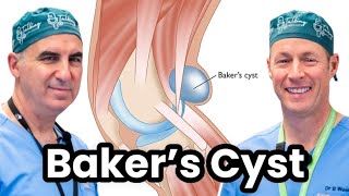 Understanding and Treating Bakers Cyst [upl. by Heindrick]