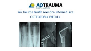 Osteotomy Week 7 May 30 Periarticular Osteotomies around the knee [upl. by Retrac]