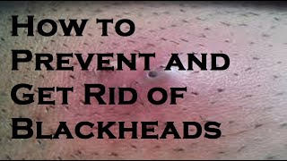 How to Prevent and Get Rid of Blackheads [upl. by Nessim]