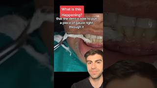 Pulling Gauze THROUGH A Tooth [upl. by Curcio]