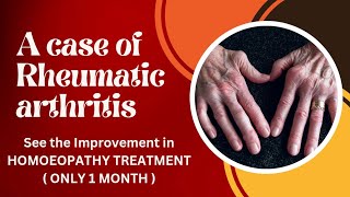 Rheumatic Arthritis  ব্যাথা এবং ফোলা মাত্র এক মাসেই অনেকটা কম  রোগীর নিজের মুখে শুনুন [upl. by Ssidnac]