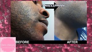 Shave bump treatment razor bump treatment 8 easy steps [upl. by Garfinkel]