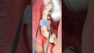 Indirect bonding of the lingual selfligating braces [upl. by Aissenav]