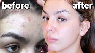 HOW I CLEARED MY SKIN  BENZOYL PEROXIDE FOR ACNE [upl. by Rorke]