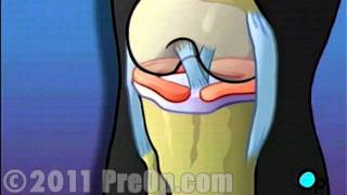 Arthroscopic Meniscus Repair of Knee PreOp® Patient Education HD [upl. by Yssirc463]