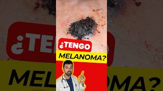 ¿Ese Lunar es un MELANOMA Descubre el ABCDE del Melanoma Maligno [upl. by Yart167]