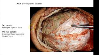 Brain Meninges and Dural Venous Sinuses [upl. by Ezirtaeb]