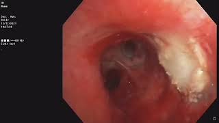 Central Airway Tumor  Bronchoscopic recanalisation  Pleomorphic adenoma [upl. by Gregory]