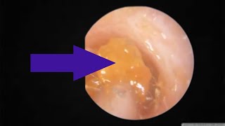 ear wax blugs for ear wax removal [upl. by Poler79]