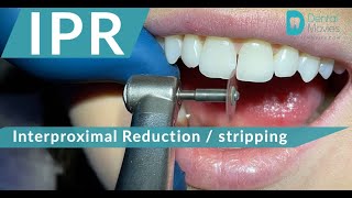 IPR 🪚🦷 Interproximal Reduction  stripping [upl. by Lord535]