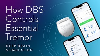 How Deep Brain Stimulation DBS can better control your Essential Tremor Symptoms [upl. by Sachsse]