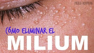 Granitos en los ojos CÓMO ELIMINAR EL MILIUM [upl. by Allimak]