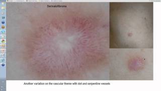 Dermoscopy Made Simple  Dermatofibroma [upl. by Collette]