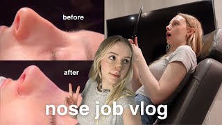 nose job vlog  rhinoplasty recovery amp results [upl. by Lilac838]