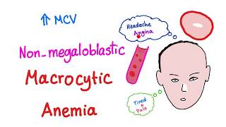 Nonmegaloblastic Macrocytic Anemia [upl. by Oemor]