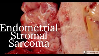 Digital Surgical Pathology 38 Endometrial Stromal Sarcoma [upl. by Boylan]