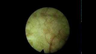 Cystitis cystica focal inflammation of the bladder Intertitial cystitis [upl. by Ailla]