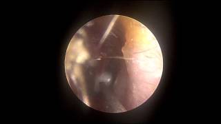 Otitis Media and Myringotomy in the Office Ear drainage of fluid [upl. by Roma]