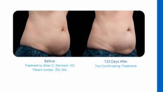 CoolSculpting Slides Irvine CA [upl. by Mandal416]