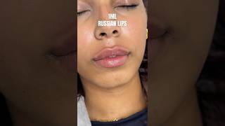 1ML RUSSIAN LIP FILLER russianlips lipfiller lipfillers lipfillerinjections lipfillerresults [upl. by Truelove395]