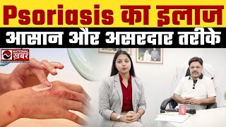 Best treatment for Psoriasis Itching redness and patches  Pankaj Bharti [upl. by Frolick]