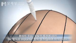 비절개모발이식 수술과정 FUE Hair Transplantation [upl. by Jacklyn]