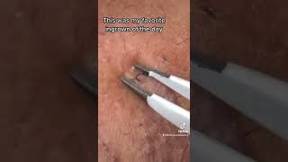 Satisfying Beard Ingrown Hair Removal [upl. by Ellenyl779]