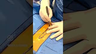 Csection Scar Revision Under Local Anesthesia [upl. by Gathers]