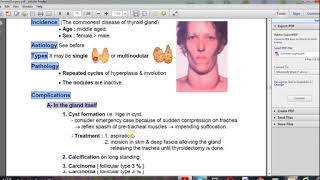 goiter thyroid 2 شرح [upl. by Homer146]