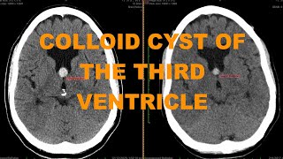 Clinical case  enlarging colloid cyst of the third ventricle  important finding not to miss on CT [upl. by Chansoo285]