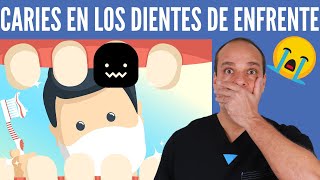 CARIES en los DIENTES de ENFRENTE 😱 2 Técnicas SEGURAS para Evitarlas GARANTIZADO 💪 [upl. by Dumond]