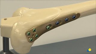 Femur Distal  Malalignment and Deformity  Biplanar ClosedWedge Osteotomy and Fixation [upl. by Cirre]