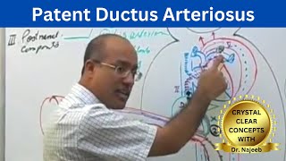 Patent Ductus Arteriosus  PDA [upl. by Analahs611]